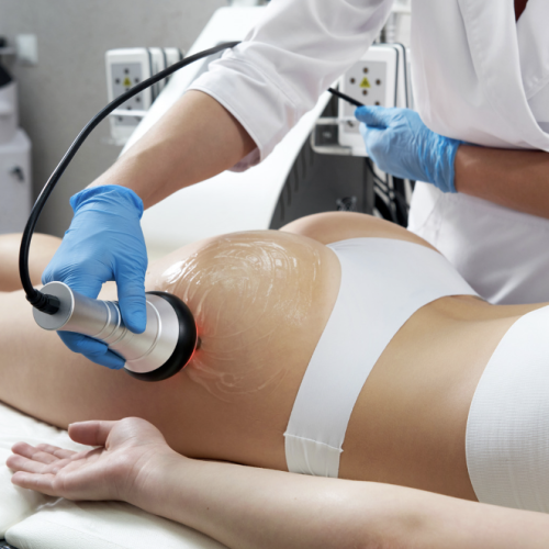 radio frequency treatment illustration